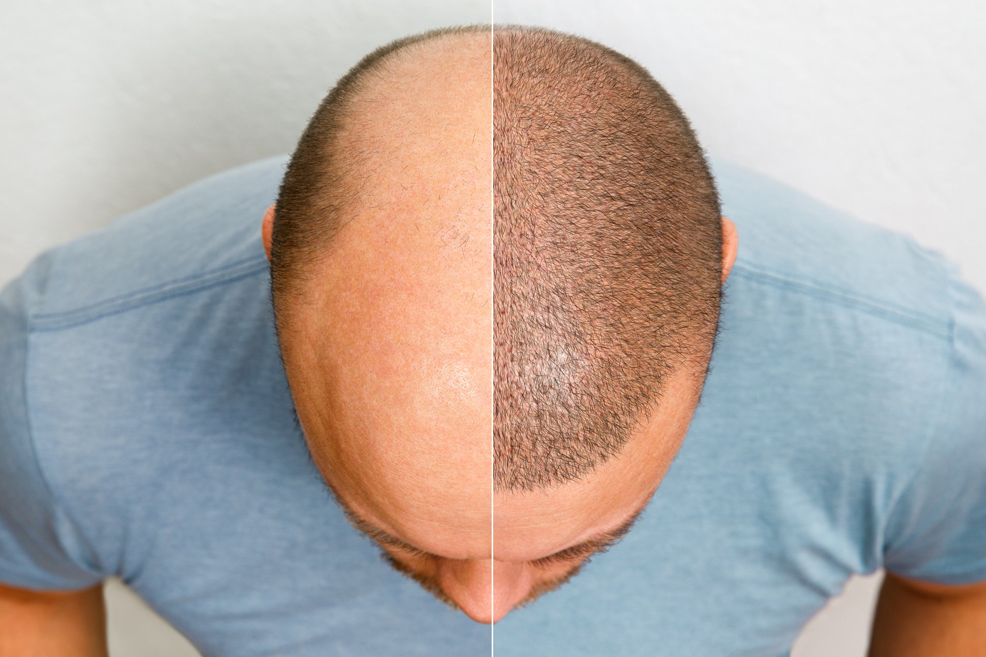 3d scanning for hair loss